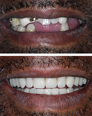 implant supported dentures