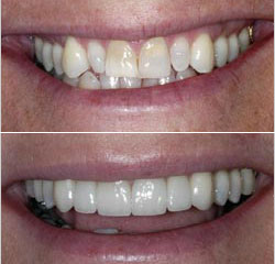 veneers